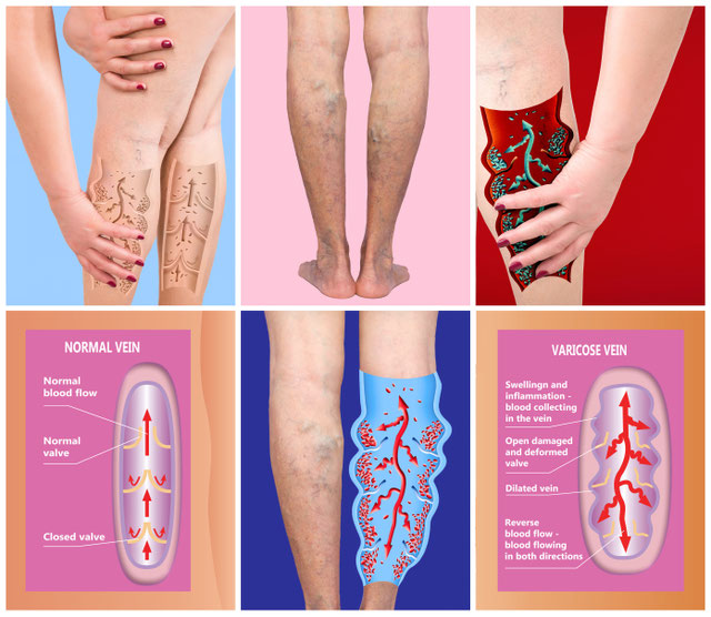 What is DVT? Signs, Symptoms, Causes and Testing Varicose Vein