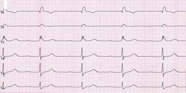 Rechtsschenkelblock im EKG - Fokus-EKG