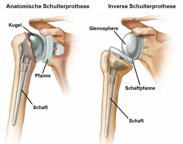 Inverse Schulterprothese Grad Der Behinderung www.ortho-clinic.ch