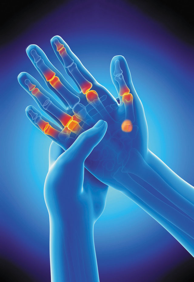ArthroseBehandlung Mikroinvasive Therapie Bern