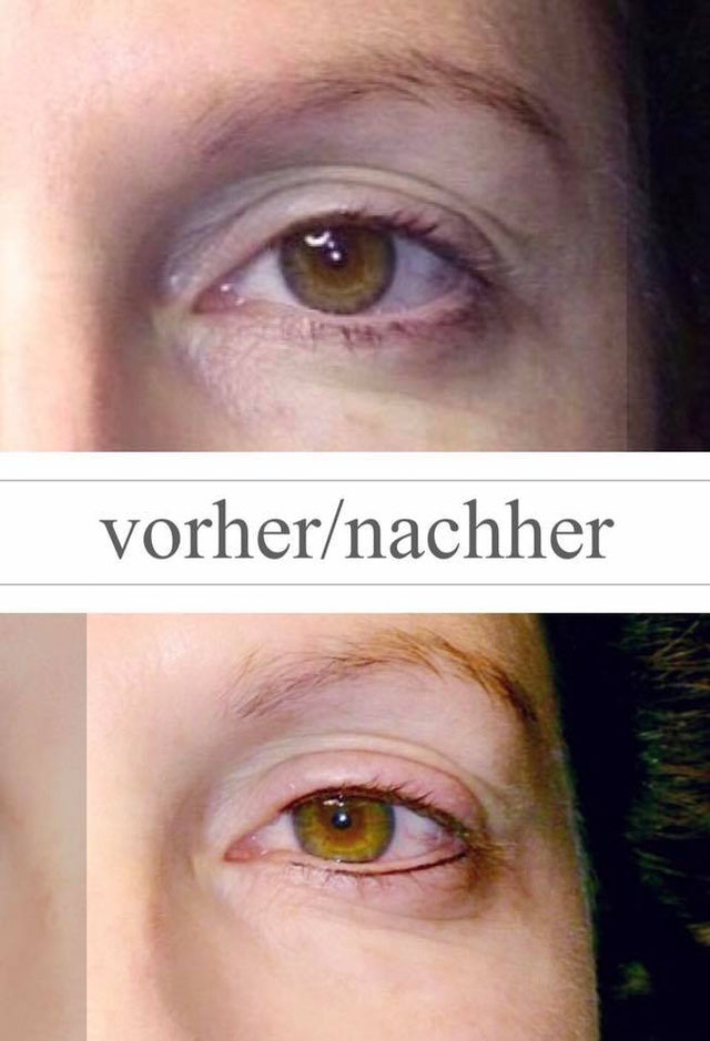 Wimpernkranzverdichtung oben Permanentyoung Nicole Scherz