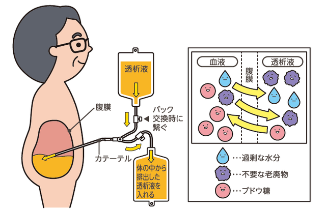 腹膜透析