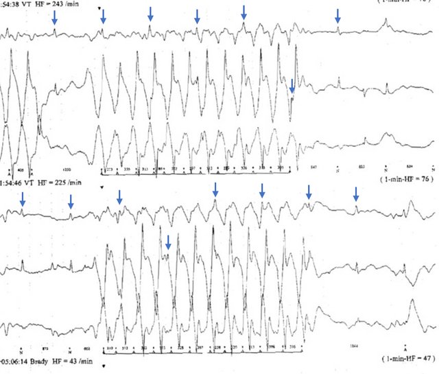 Arrhythmien vortäuschende Artefakte - Fokus-EKG