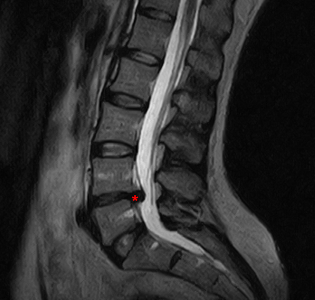 L'ernia del disco intervertebrale Benvenuti su