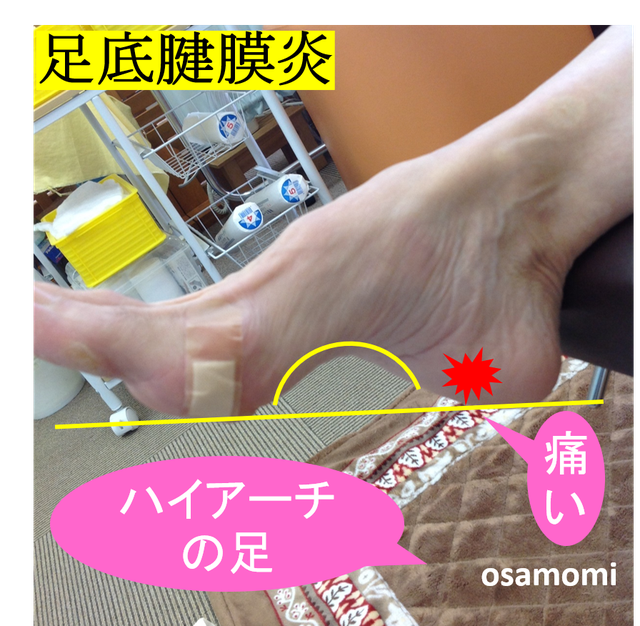オサモミ整体院 足底腱膜炎 ハイアーチ