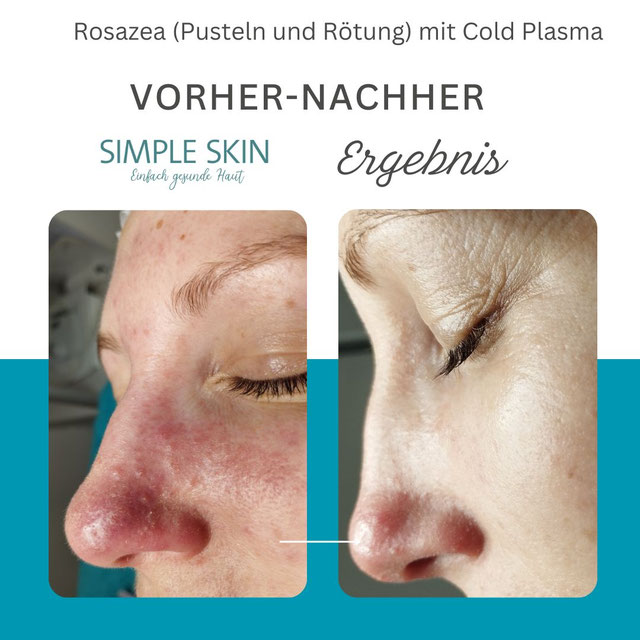 Rötung Pickel Rosazea Cold Plasma