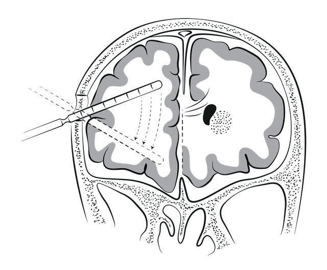 Psychochirurgie Histoire Lobotomie Neurochirurgien Marseille Aix psychochirurgie-histoire-lobotomie-neurochirurgien-marseille-aix