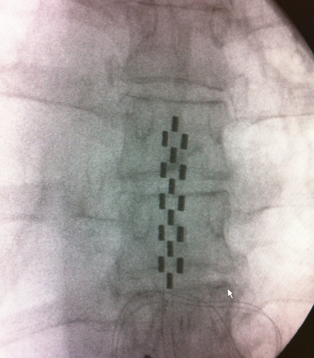 Les complications de la stimulation médullaire - Neurochirurgien ...