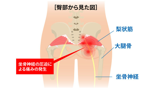 梨状筋の解剖図