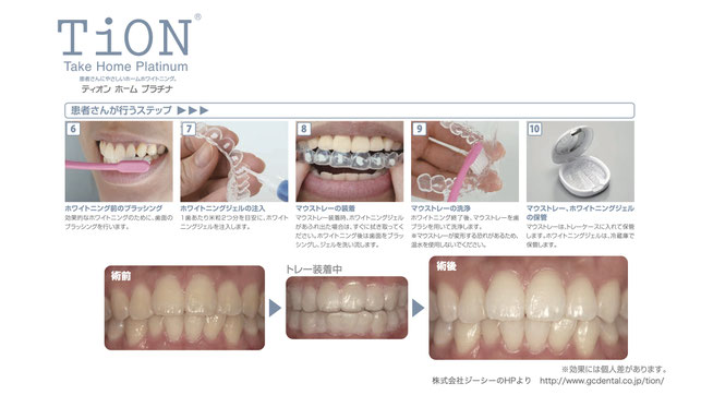 白い歯ホワイトニングホームホワイトニング