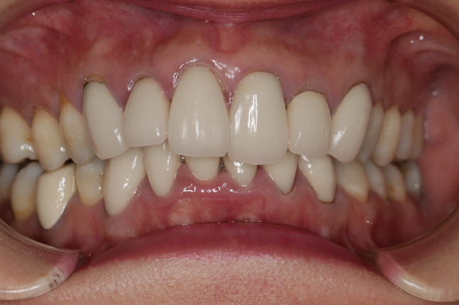 歯茎の再生治療と審美歯科　５０