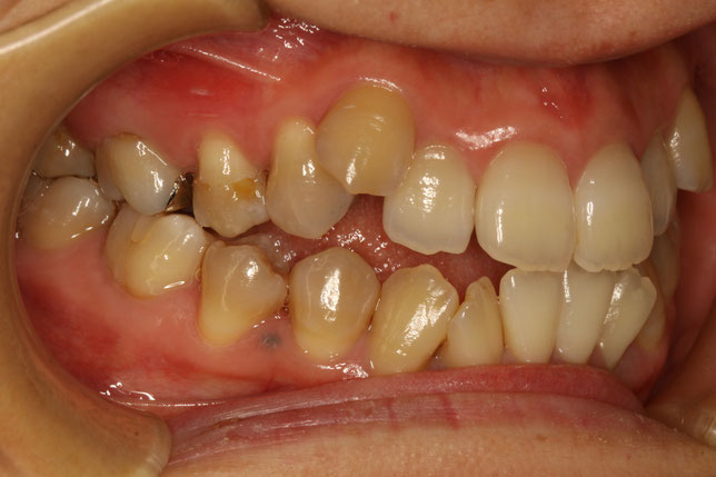 開咬・オープンバイトの矯正治療ケース　