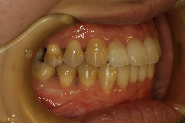 開咬・オープンバイトの矯正治療ケース　