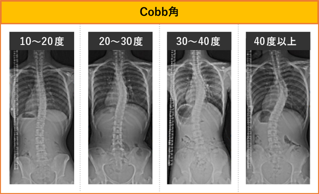 cobb角の程度による分類は4種類です