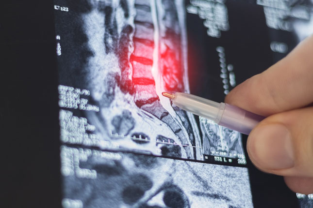 Bandscheibenvorfall Physiotherapie Wellsana