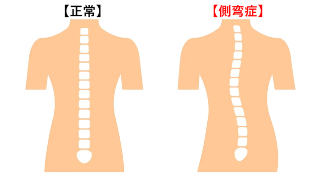 通常は肩甲部、対側背部、背部の対側腰部で捻じれて弯曲することが多い