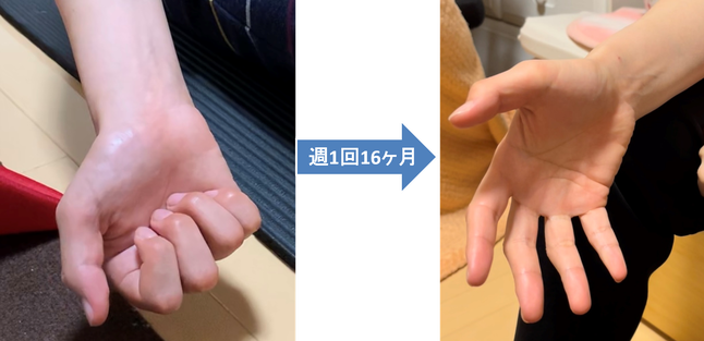 手指伸展　マヒ回復リハビリ教室きゃっちぼーる