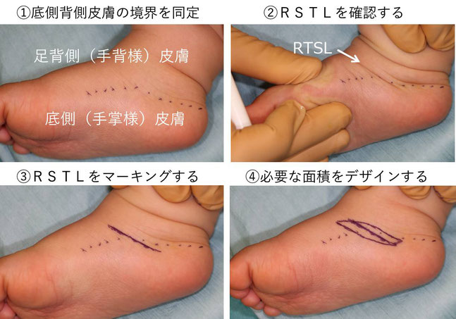 整容性を高める皮膚外科技術 - 手の小児形成外科医 齊藤晋の