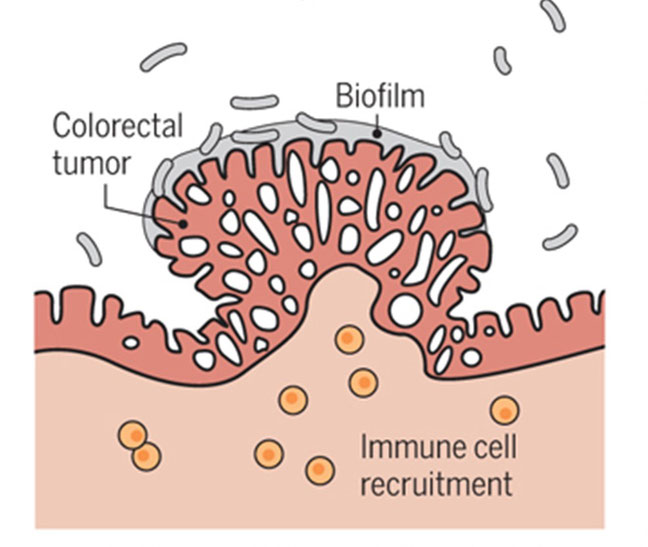 Impact of the intestinal microbiome on colorectal cancer metastasis