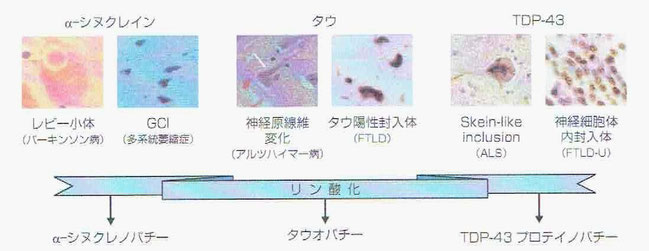 パーキンソン病と活性酸素との関係