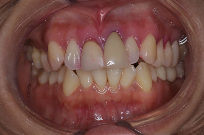 前歯の差し歯の長さが長いのが気になってしまうケース