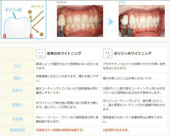 八戸市　くぼた歯科医院　ホワイトニング