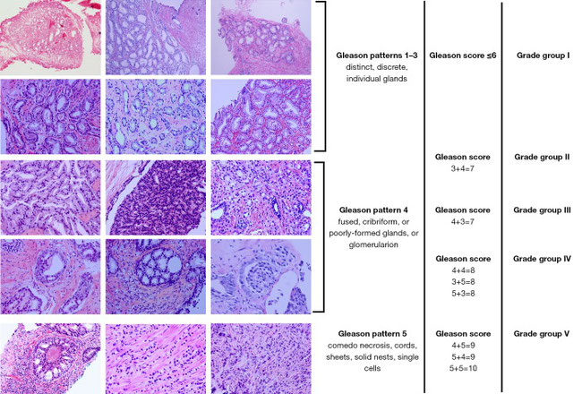adenocarcinoma prostatico score 6 di gleason adenocarcinoma prostatico score 6 di gleason