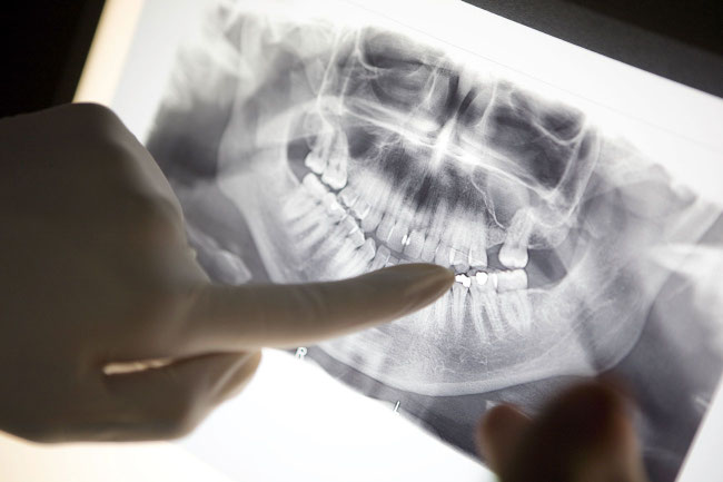 Patient bei einer Zahnkontrolluntersuchung im Behandlungszimmer der Zahnarztpraxis Dr. Jansen in Teufen