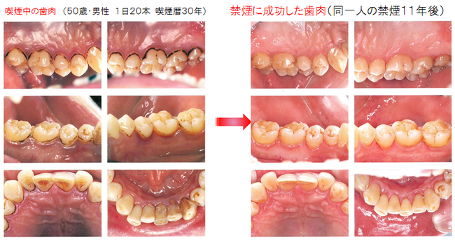 八戸市　くぼた歯科　歯医者　禁煙外来　歯周病　口臭