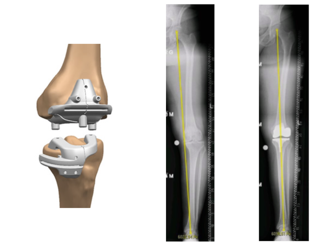 Arthrose des Kniegelenkes - vor und nach der Versorgung mithilfe der maßgefertigten patientenindividuellen VISIONAIRE-Schablone