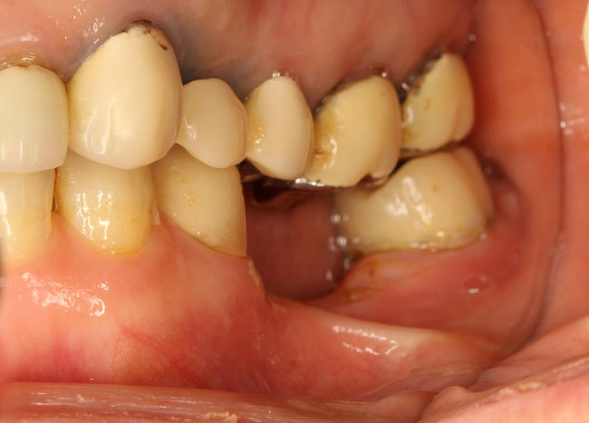 歯を抜いた後の骨と歯茎の吸収