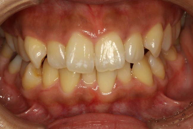 前歯の歯並び