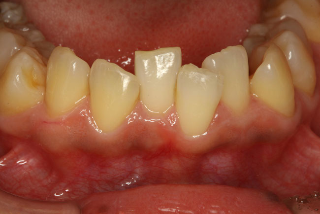 歯並び治療
