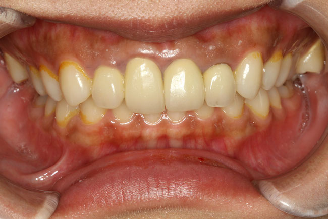 前歯の形