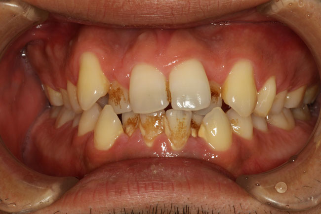 歯並びと歯の清掃性