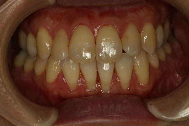 反対咬合の矯正治療後の歯茎の退縮