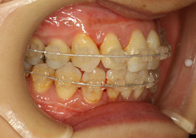 歯列矯正中のクリーニング