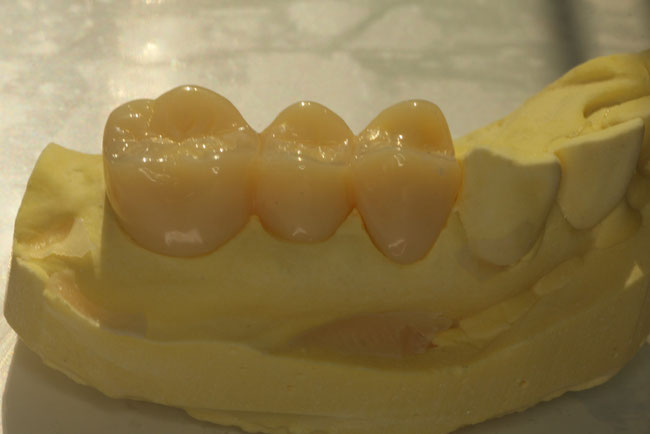 矯正治療中に使用する仮歯