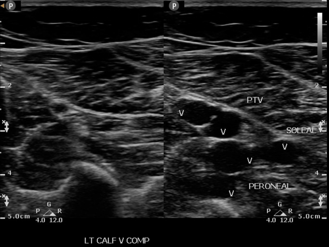 Left PTV, PERO and Soleal Veins with Compression