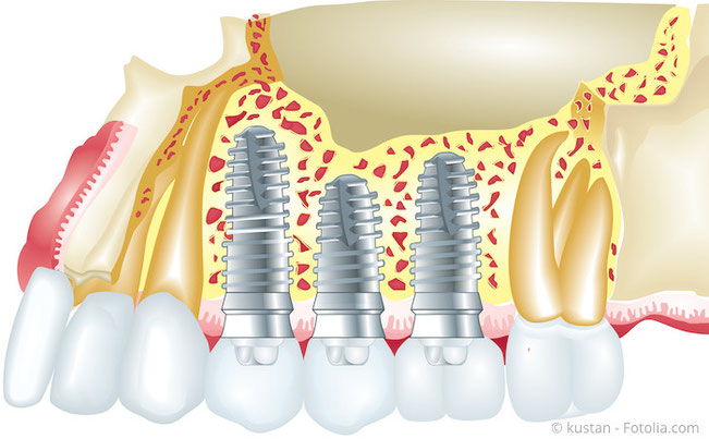 Implantate sind künstliche Zahnwurzeln, die an Stelle fehlender Zähne in den Kiefer eingesetzt werden. (© kustan - Fotolia.com)