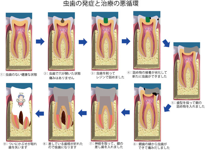 虫歯治療の再発・悪循環