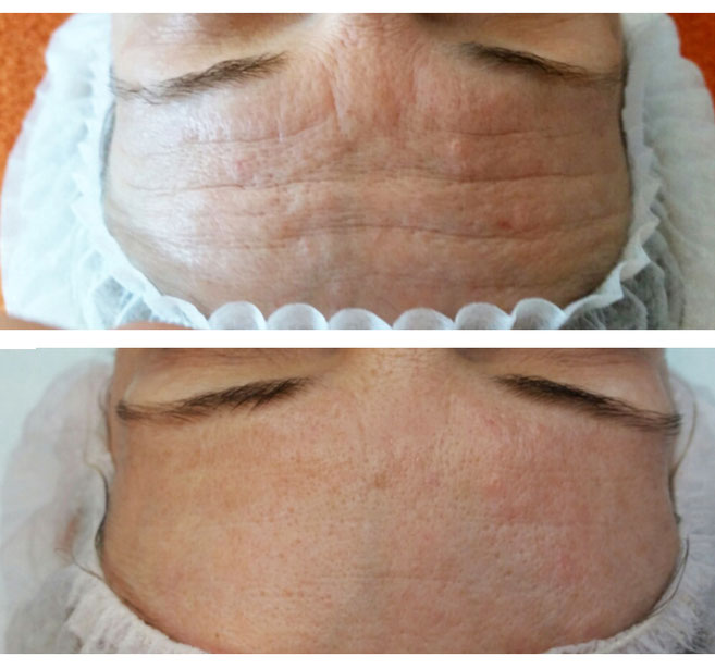 Mit der Geneo X Behandlung lassen sich Stirnfalten ohne Botox wegglätten