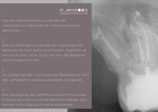 Bild: Schmerzen nach Wurzelbehandlung, Zahnarzt Hamburg, Dr. Jacob, Dr. Jakob, Wurzelbehandlung, Zahnschmerzen