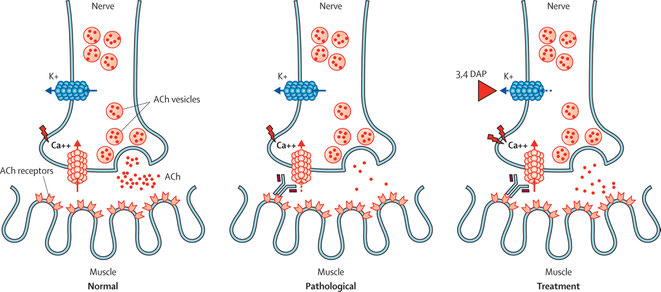 Pathophysiology of LEMS and effects of symptomatic treatment