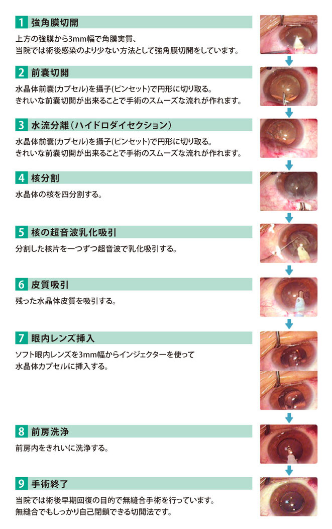 白内障日帰り手術