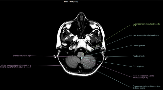 Myelencephalon, Medula oblongata, Lateral aperture, Fourth ventricle, Choroid plexus, Tonsil of cerebellum, Cisterna magna MRI