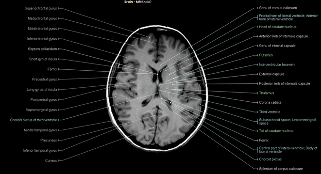 Genu of corpus callosum, Head of caudate nucleus, Genu of internal capsule, Putamen, External capsule, Thalamus, Third ventricle, Tail of caudate nucleus, Fornix, Choroid plexus, Splenium of corpus callosum MRI