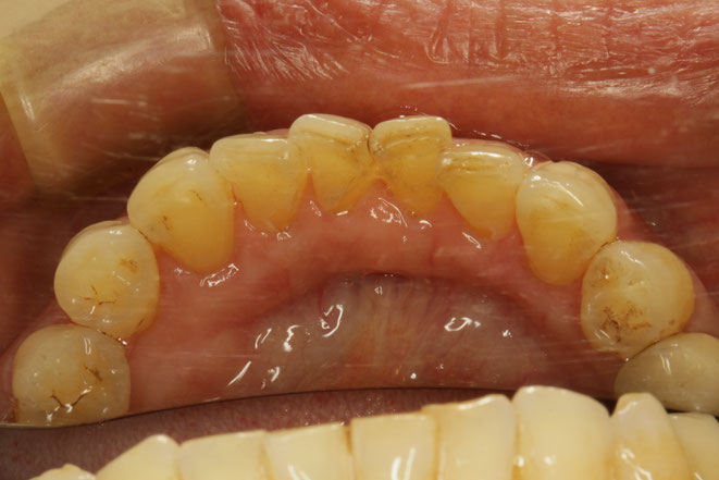 下の前歯の裏側の歯茎下がってしまったケース