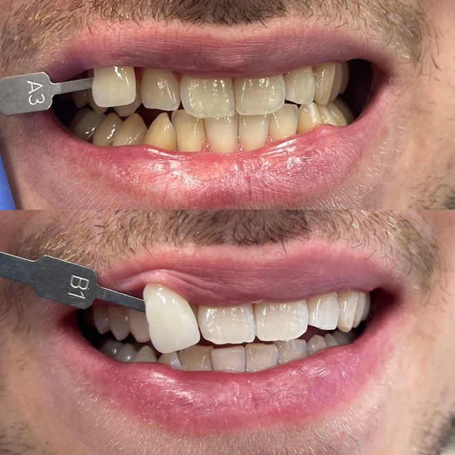 Bleaching Kosten & Info's beim Zahnarzt in Bern ZahnInsel