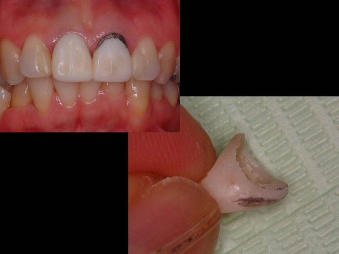 仮歯を修正しながら、歯ぐきの形態を整えていきます。この治療ステップによって、炎症のない綺麗な歯ぐきに整えます。